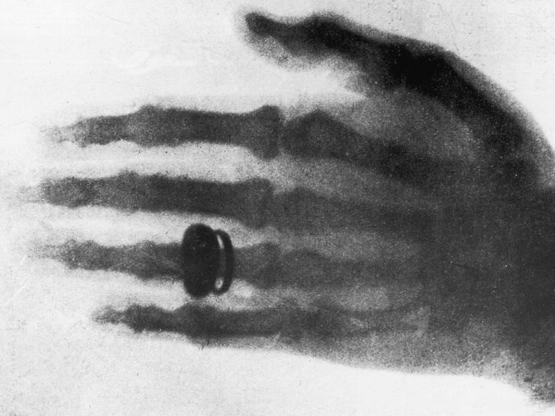 First X-ray Photograph